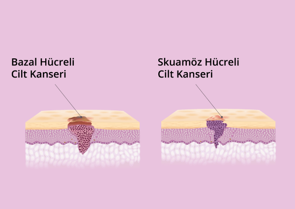 Cilt Kanseri (Melanom Dışı) Melanom Dışı Cilt Kanseri Nedir?