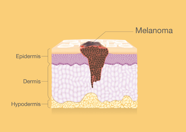 Cilt Kanseri (Melanom) Cilt Kanseri (Melanom) Nedir?