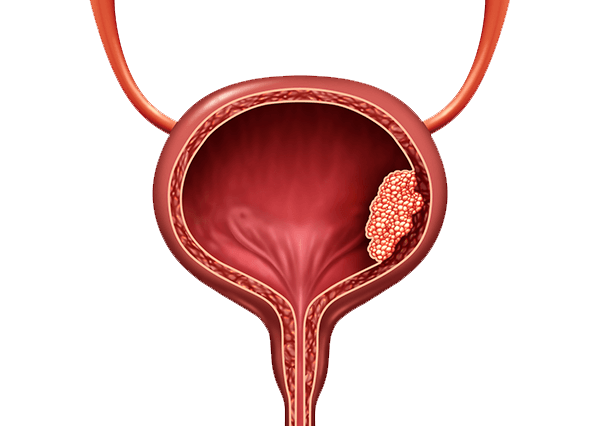 Mesane Kanseri Mesane Kanseri Nedir?